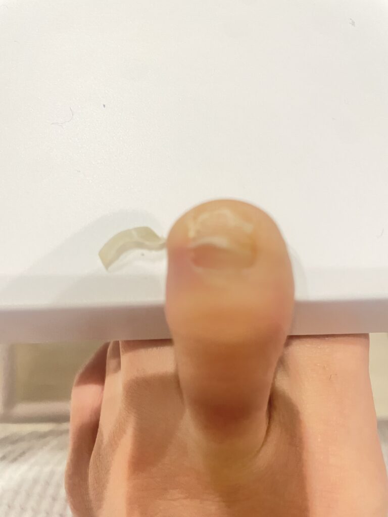 足の指の爪甲剥離