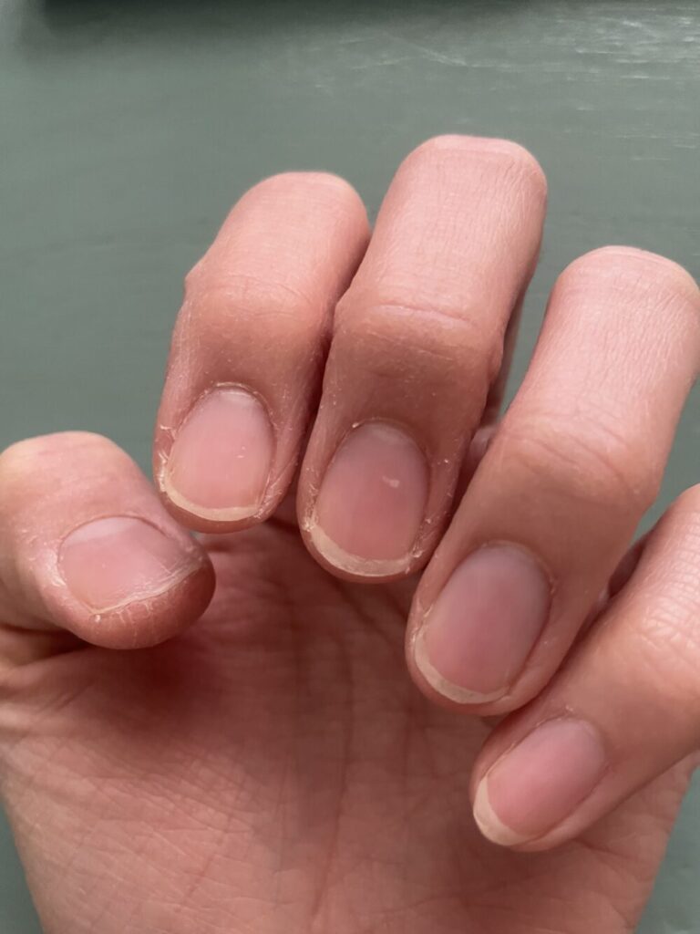 がさがさの手、手荒れ、ささくれ、ひび割れ